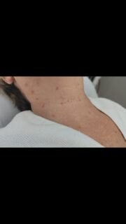 Bioestimulador de colágeno para rejuvenecimiento de una de las zonas que más nos preocupan con el paso de los años,el cuello.
Profhilo es un tratamiento de 3 sesiones separadas las dos primeros por un mes y la tercera a los 3 o 6 meses.
El resultado es una estimulación de colágeno que se visualiza en una mejora de la calidad de la piel, mucho más elástica y rejuvenecida.
No rellena, no aporta volumen, si es tu caso, agenda tu cita de valoración con nuestro doctor 👨🏻⚕️ 💉
Estaremos encantados de atenderte en el 604985625📲📆
C/Dinastía Músicos Palatin 11 frente a Viding la Rosaleda.