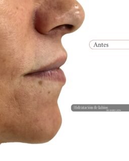 💋✨ Hidratación de labios con ácido hialurónico
Labios más hidratados, suaves y con un acabado natural, gracias a la reposición de ácido hialurónico de baja densidad, diseñado para mejorar la textura sin aportar volumen excesivo.
Este tratamiento ayuda a:
✔ Mejorar la hidratación profunda
✔ Definir suavemente el contorno
✔ Suavizar grietas y sequedad
✔ Potenciar el aspecto saludable del labio
Un resultado sutil y muy natural, realizado por el Dr. Mario León, especialista en medicina estética en Sevilla.
📍 Clínica Belveh — Medicina Estética en Sevilla
📞 604 985 625
✨ Si te gusta este resultado, déjalo en comentarios.
⚕️ Los resultados pueden variar en cada paciente. Siempre es necesaria una valoración médica previa.
#antesydespués #hidrataciondelabios