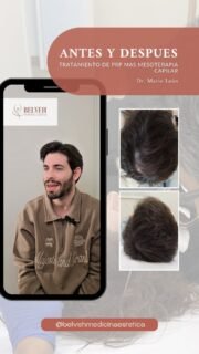 💆♂️✨ Recuperar la densidad del cabello sí es posible
La caída del cabello y la pérdida de densidad son dos de los motivos más frecuentes por los que nuestros pacientes buscan ayuda.
En este vídeo, uno de ellos comparte su experiencia con nuestro tratamiento combinado de PRP + mesoterapia capilar, una opción muy demandada para fortalecer el folículo, mejorar el grosor y revitalizar el cabello desde la raíz.
Gracias por confiar en Clínica Belveh para tu recuperación capilar.
Nos encanta acompañarte en cada paso del proceso. 🤍
📍 Clínica Belveh — Medicina Estética en Sevilla
📞 604 985 625
✨ Reserva tu valoración y te asesoraremos sobre el tratamiento más adecuado para tu tipo de cabello.
⚕️ Los resultados pueden variar según cada paciente. Es necesaria valoración médica previa por parte de nuestros especialistas.