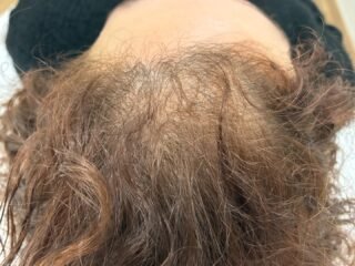 ✨ Evolución real en tratamiento capilar ✨

Entre la primera imagen y las siguientes han pasado 2 meses y medio de tratamiento 📆
✔️ Medicación oral
✔️ 1 sesión de PRP capilar
✔️ 2 sesiones de mesoterapia capilar

📈 El resultado: se aprecia una mejora en densidad, calidad del cabello y fortalecimiento del folículo, pero lo más importante es que el tratamiento continúa, porque el crecimiento capilar es un proceso progresivo y requiere constancia.

🧬 En los tratamientos capilares no hay milagros, hay ciencia, seguimiento médico y tiempo.

⚠️ Cada paciente responde de forma diferente y los resultados pueden variar. Siempre es necesaria una valoración médica previa.

📍 Si notas caída, afinamiento o pérdida de densidad capilar, en Clínica Belveh (Sevilla) podemos ayudarte con un plan personalizado.

📲 Pide tu valoración en el 604 985 625 y empieza a cuidar tu cabello desde la raíz.