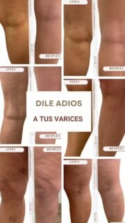 ✨ Di adiós a las várices y luce piernas saludables✨

Las varices no solo son un problema estético, también pueden causar dolor, pesadez o cansancio en las piernas. 🤎

Con los tratamientos de flebología, podemos cuidar tu circulación y mejorar la apariencia de tus piernas de manera **segura, rápida y prácticamente indolora**.

🌿 Beneficios que notarás:

* Piernas más ligeras y sin dolor.
* Adiós a las venitas visibles.
* Mejora de tu bienestar y confianza.

💡 *Nota:* En las fotos de antes y después se usaron **dos móviles distintos**, por eso la luz y la iluminación pueden variar ligeramente. ¡Pero los resultados REALES se ven👀 claramente! ✨

¡Tus piernas merecen sentirse y verse increíbles! 💫

⚠️ No se garantiza el mismo resultado en todos los pacientes.Siempre es necesaria una valoración médica previa.

🖊️Resultados mostrados con el consentimiento del paciente.

📍Si es tu caso, en Clínica Belveh podemos ayudarte.

📲 Solicita tú valoración en el 604985625 y empieza a cuidar tus piernas 🦵🦵

#varices #piernas #pesadez #flebología #sevilla